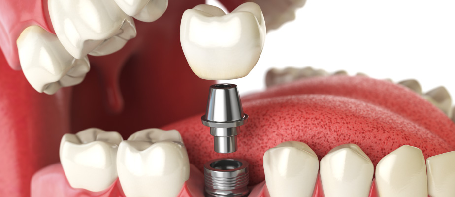 illustration of dental implant being placed