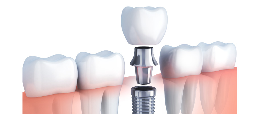 illustration of dental implant placed between teeth