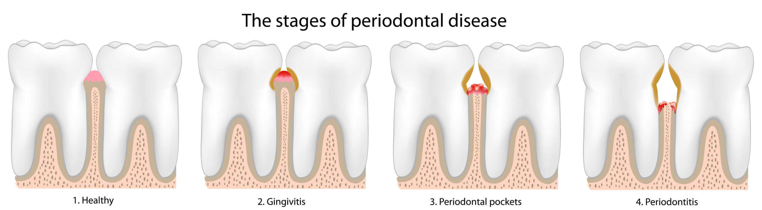 Artistic rendering describing the states of gum or periodontal disease