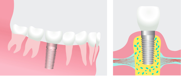 Artistic rendering of a dental implant with the titanium post in the jawbone on the left and the post topped with a dental crown on the right