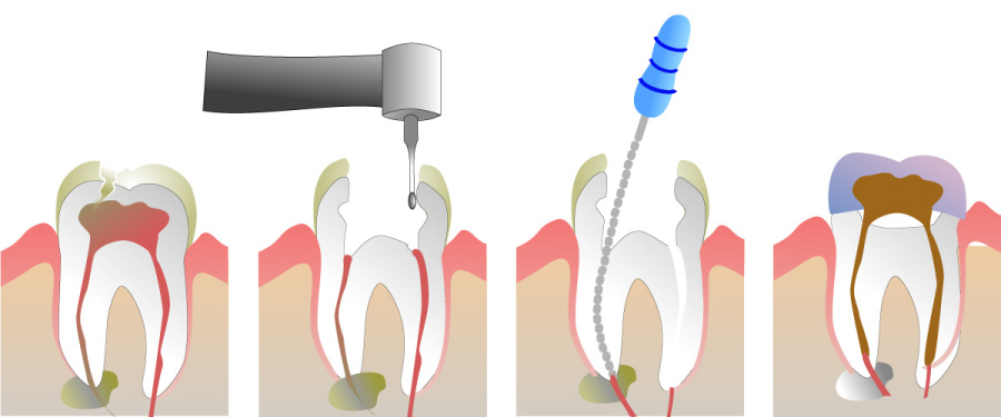 Graphic showing how a root canal is used to eliminate infection and save the natural tooth.