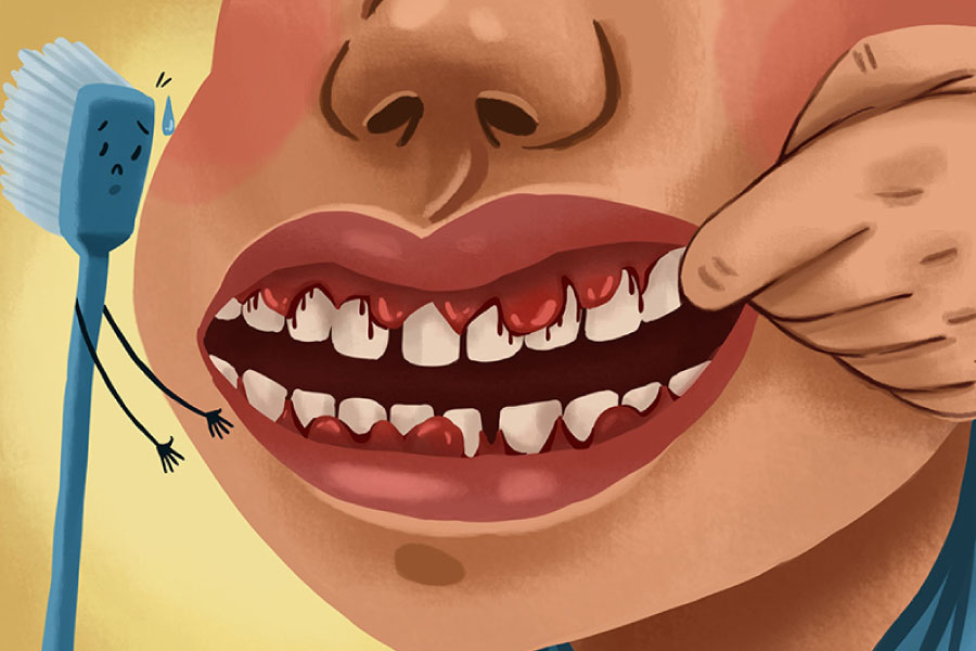 Cartoon of a mouth with bleeding gum due to gum disease.