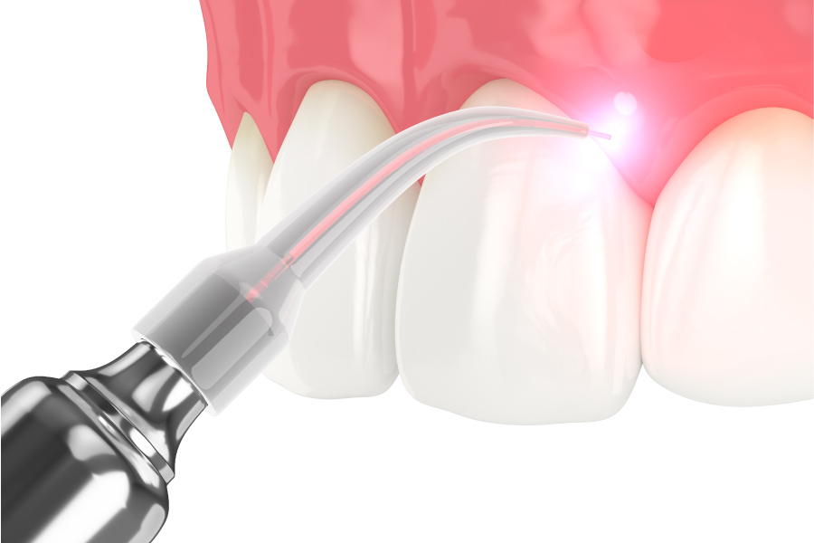 Graphic showing a laser gum treatment.