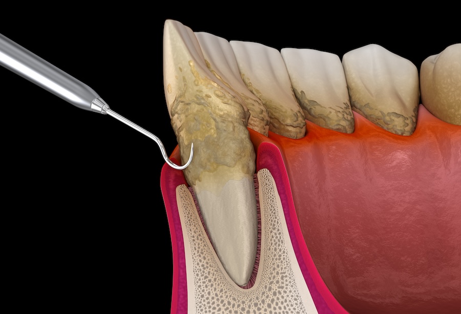 https://www.mouthhealthy.org/all-topics-a-z/gum-disease