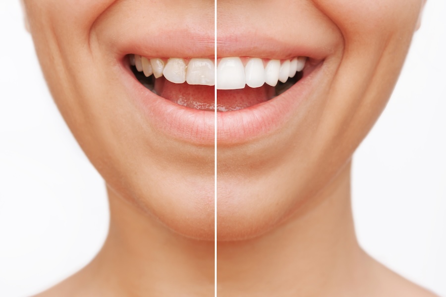 woman who is a candidate for veneers