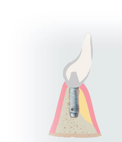 Bone Grafting