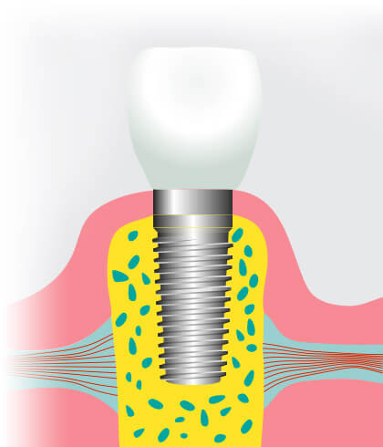 Dental Implant
