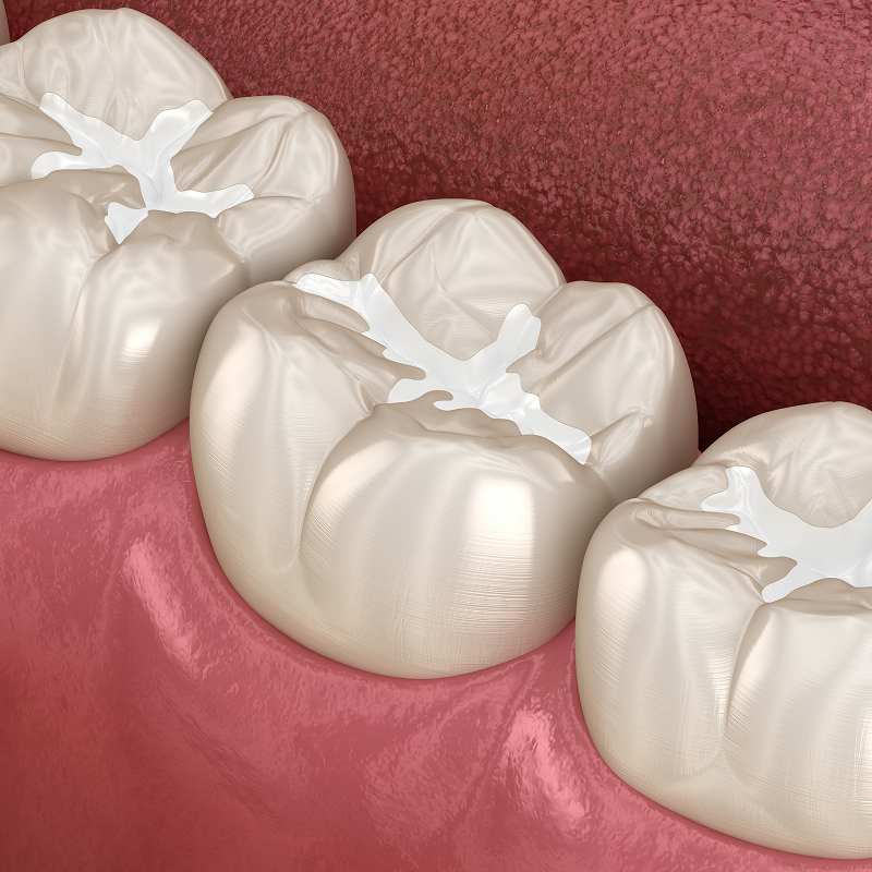 illustration of teeth with dental sealants