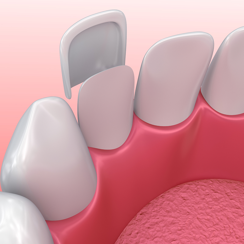 illustration of veneers