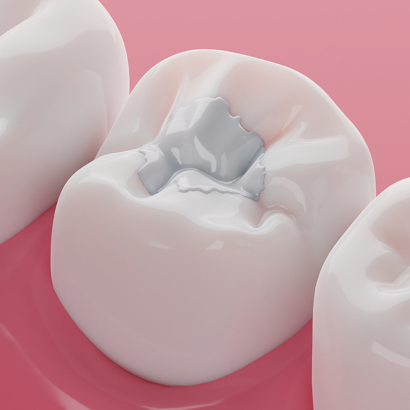 illustration of dental filling