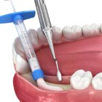 bone graft