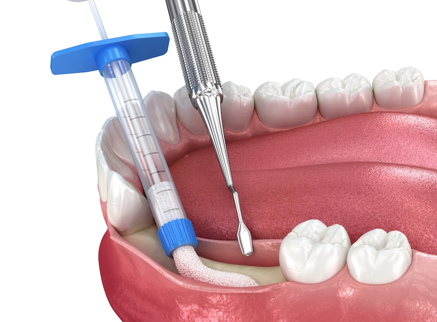 bone graft