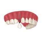 mini dental implant image
