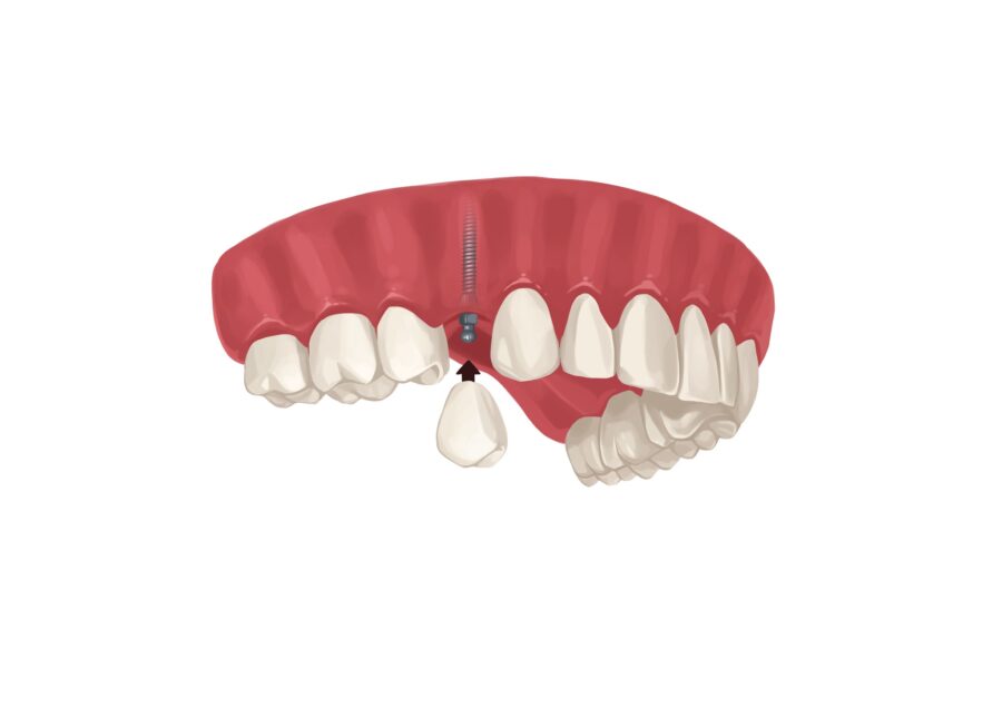 mini dental implant image