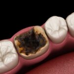 severely damaged tooth with cavity