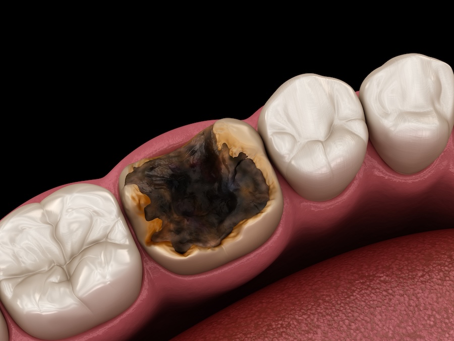 severely damaged tooth with cavity